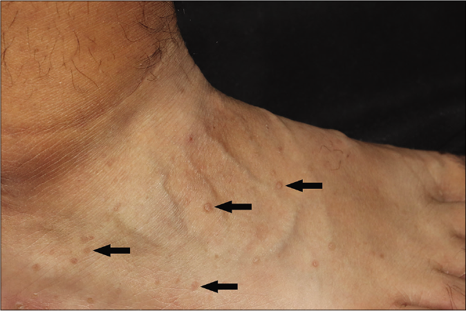 Punctate keratotic papules on the right foot (arrows)