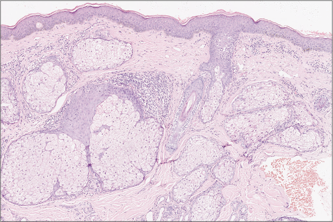Histopathology of skin lesion taken from the face reveals sebaceous hyperplasia (H and E, ×100)