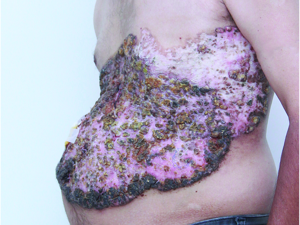 Giant ulcerated plaque with crusting on the abdomen