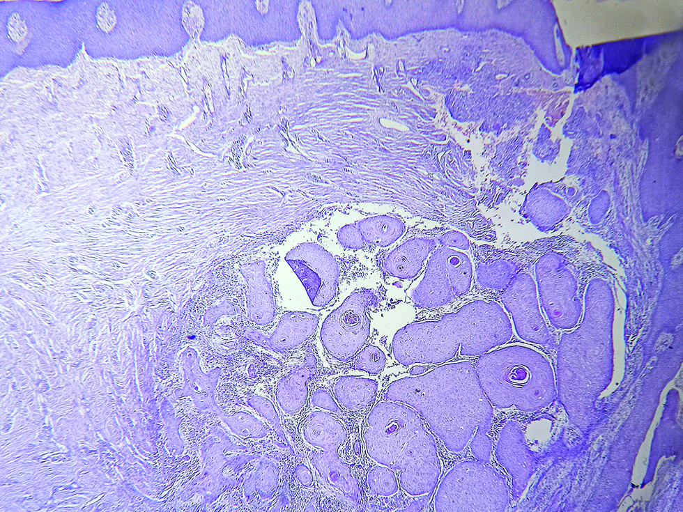 Horn pearls composed of concentric layers of squamous cells with gradually increasing keratinization towards the centre (hematoxylin and eosin, × 100)