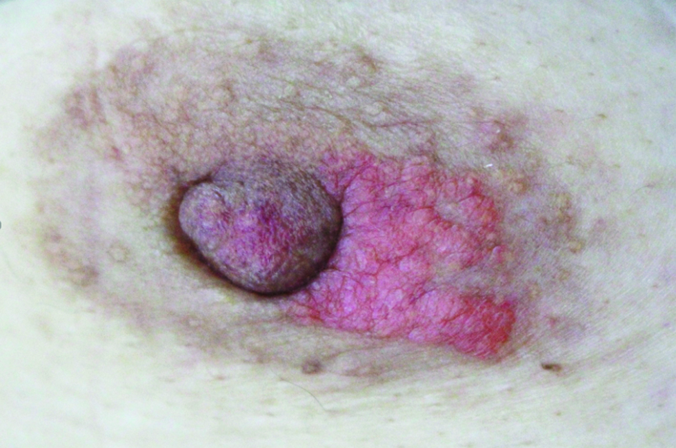 Well-demarcated, reddish orange, polygonal, flat and waxy plaques on left areola and the center of nipple