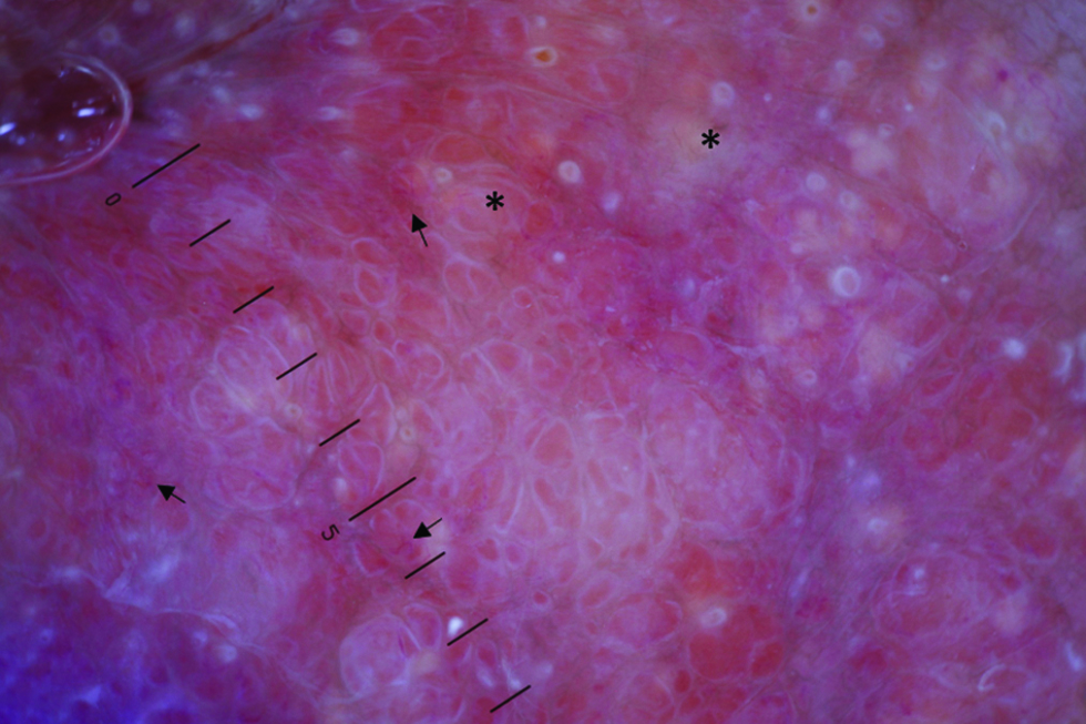 Primary Localized Cutaneous Nodular Amyloidosis On Areola Indian