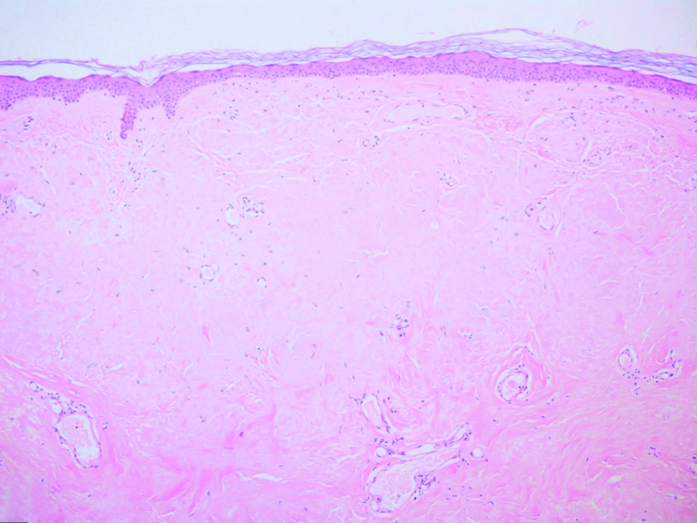 Abundant deposition of pale eosinophilic amorphous material separated by clefts in the upper dermis (H&E; original magnification: x 100)