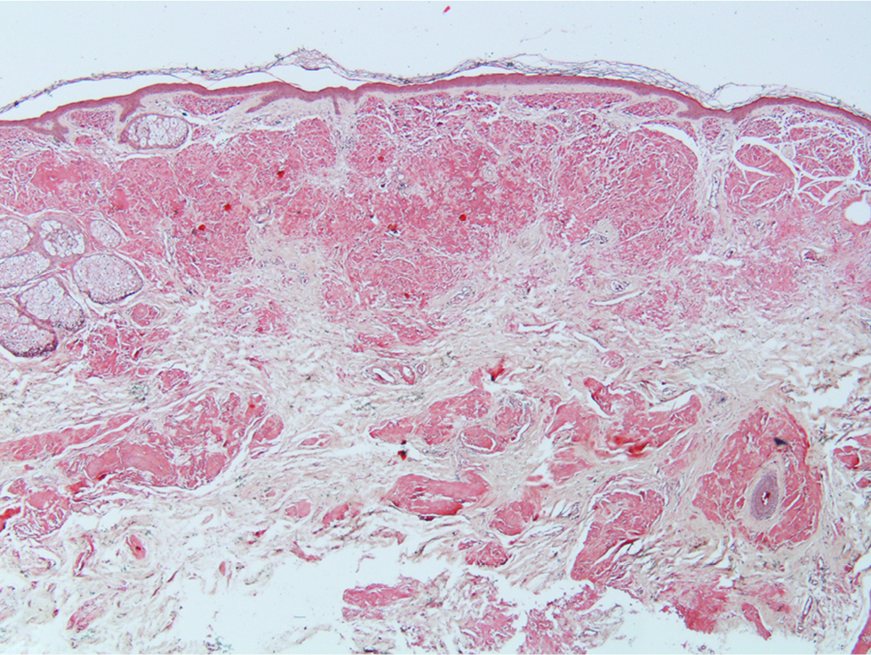 The deposited material stained positively with Congo-red (Congo-red stain; original magnification: x 40)