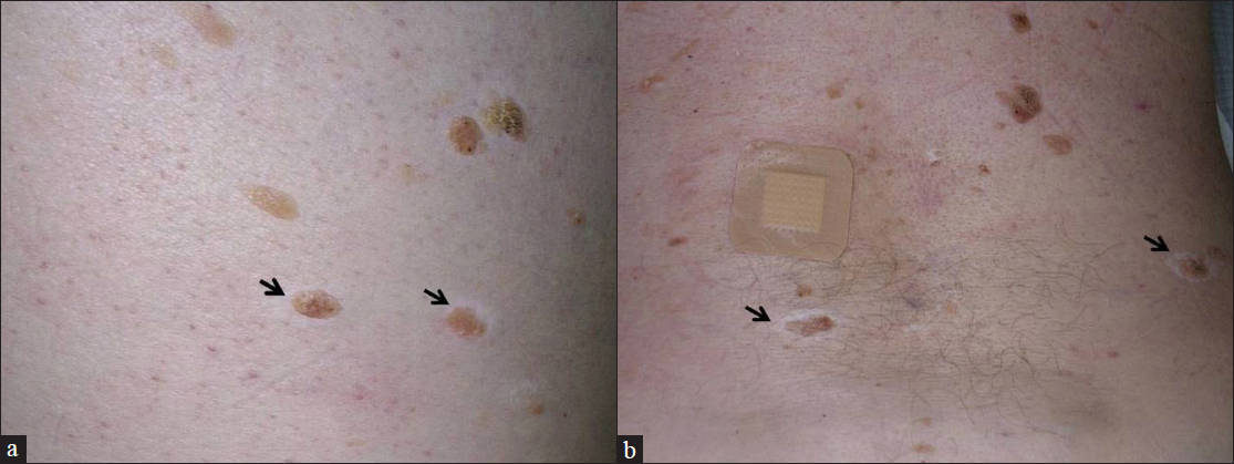 Numerous seborrheic keratosis encircled with white halos (arrows) located on the abdomen (a) and the back (b)