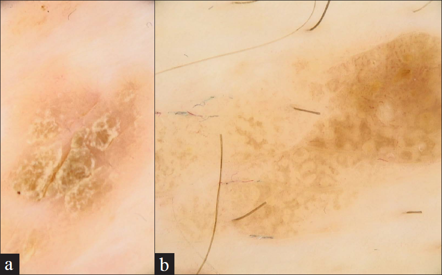 White structureless areas surrounding seborrheic keratosis that display comedo-like openings, milia-like cysts, or brain-like appearance on dermoscopy (original magnifications: a-b ×20)