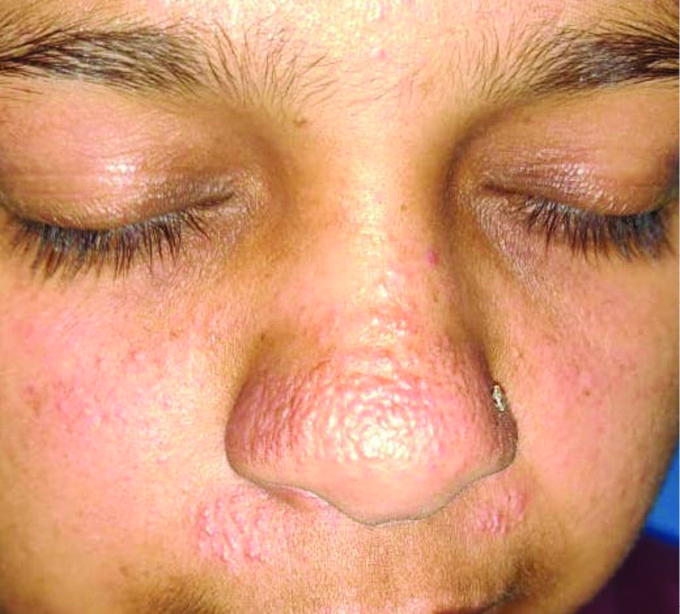 Multiple tiny pseudovesicular papules over nose and upper lip