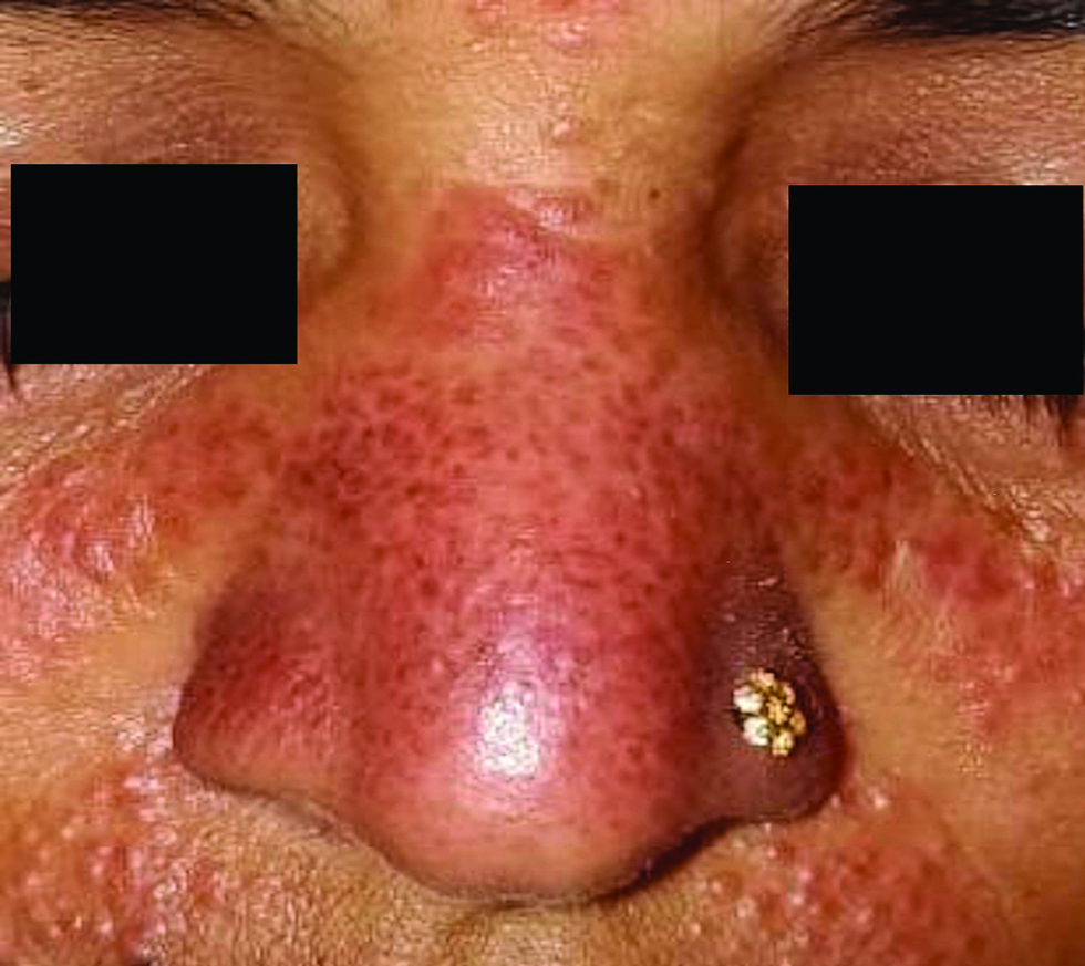 Multiple tiny pseudovescicular papules over nose, bilateral cheek and upper lip