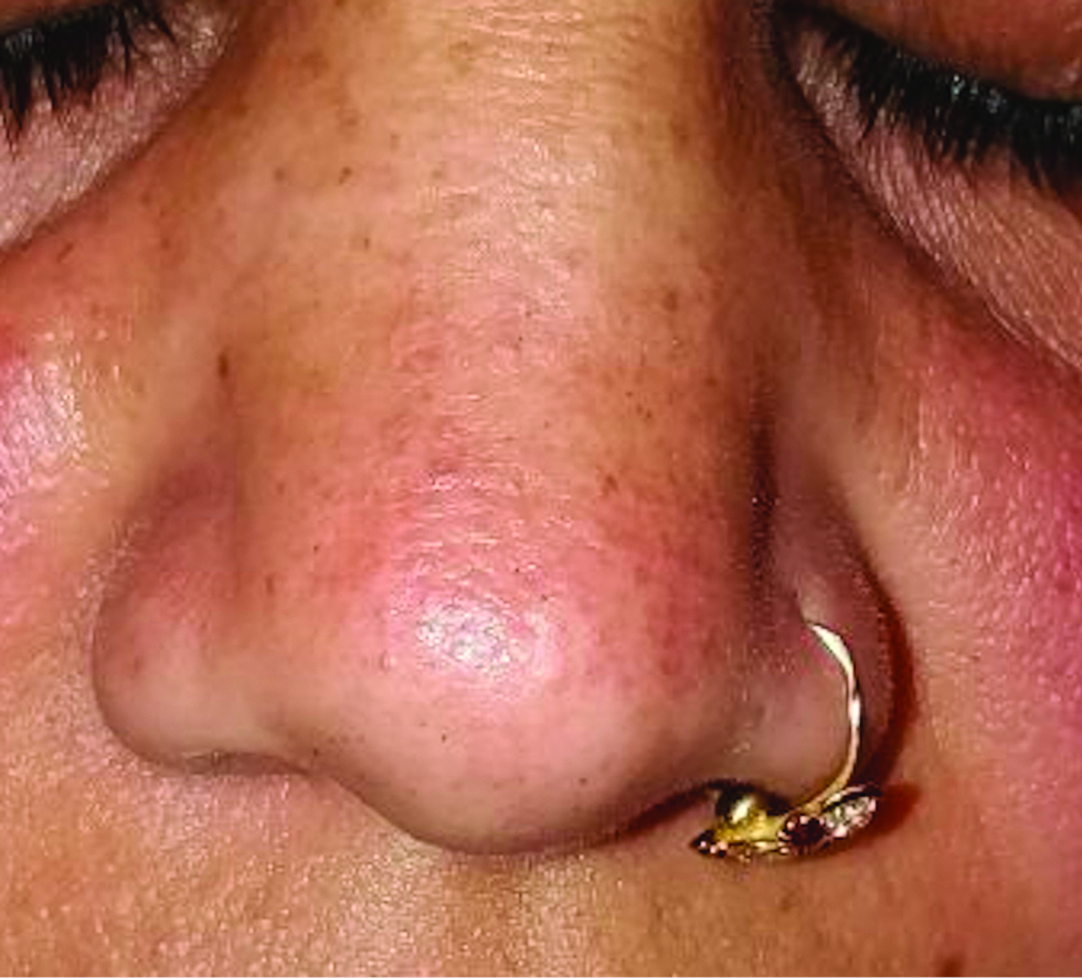 Multiple tiny pseudovescicular papules over nose and upper lip