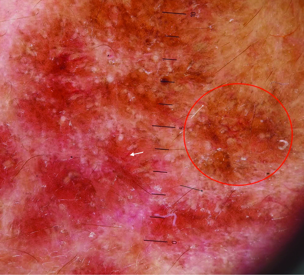 Dermatoscopic image showing focal brown dots and network (red circle) and linear capillaries (white arrow), ×10 magnification, polarized light, (Heine delta 20 dermatoscope)