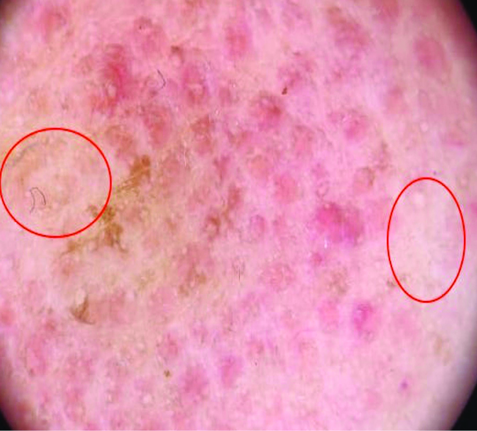 Dermatoscopic image showing red clods along with pale areas (red circle) ×10 magnification, polarized light, (Heine delta 20 dermatoscope)