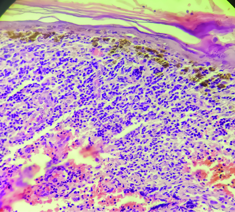 Histopathology image showing atrophic epidermis, basal cell damage with pigment incontinence. Dense lymphohistiocytic infiltrate in the upper and mid dermis (H&E × 200)