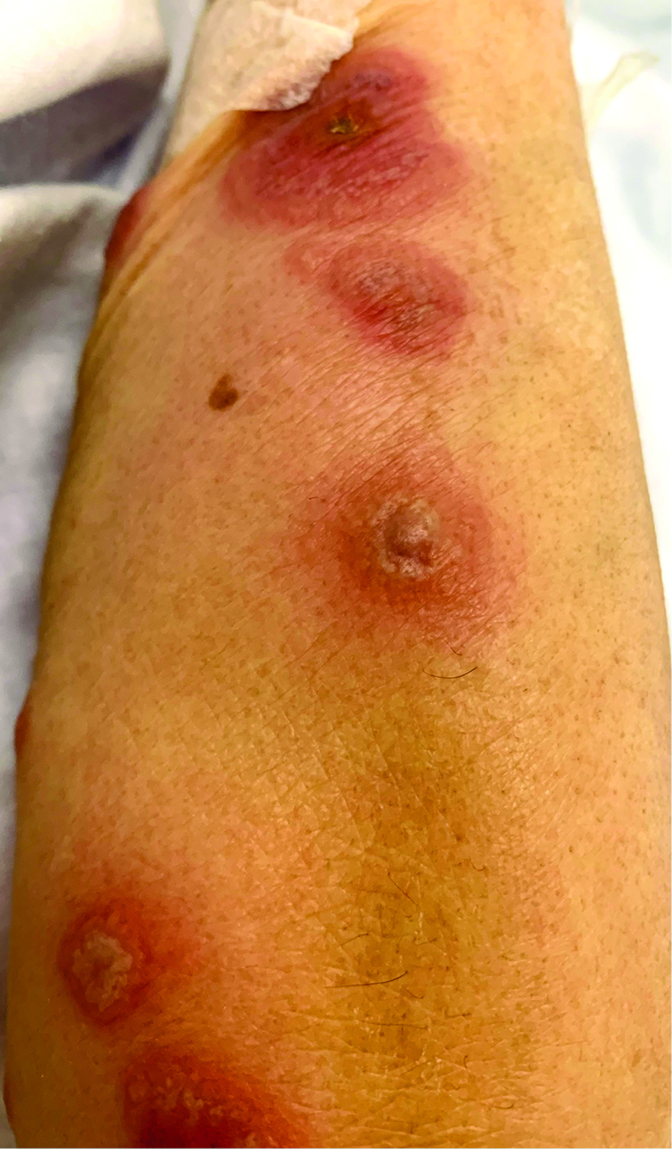 Multiple erythematous and edematous papules and plaques with bullae and pustules on the forearm of a patient following osimertinib