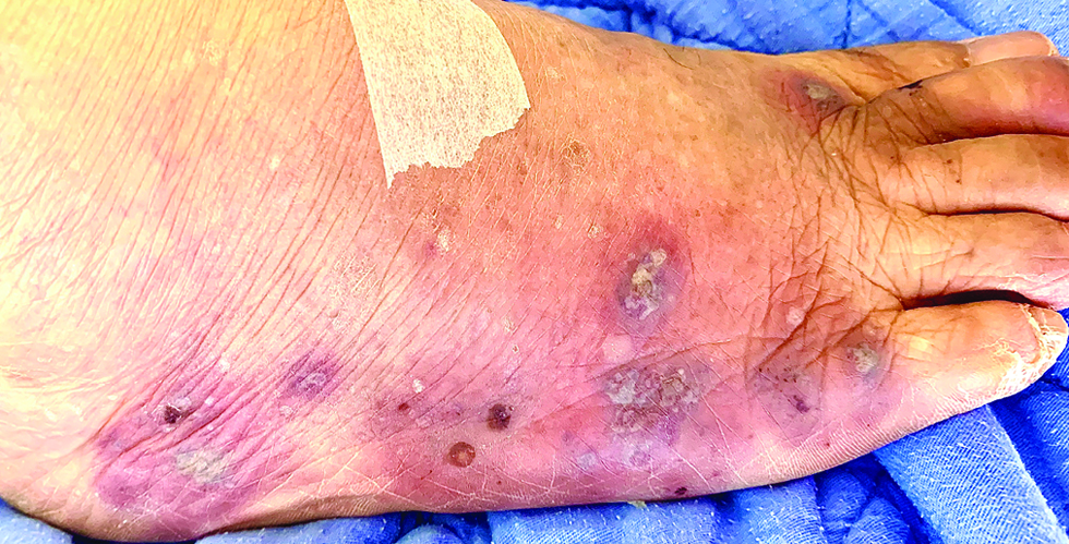 Multiple erythematous and edematous papules and plaques with bullae and pustules on the foot of a patient following osimertinib