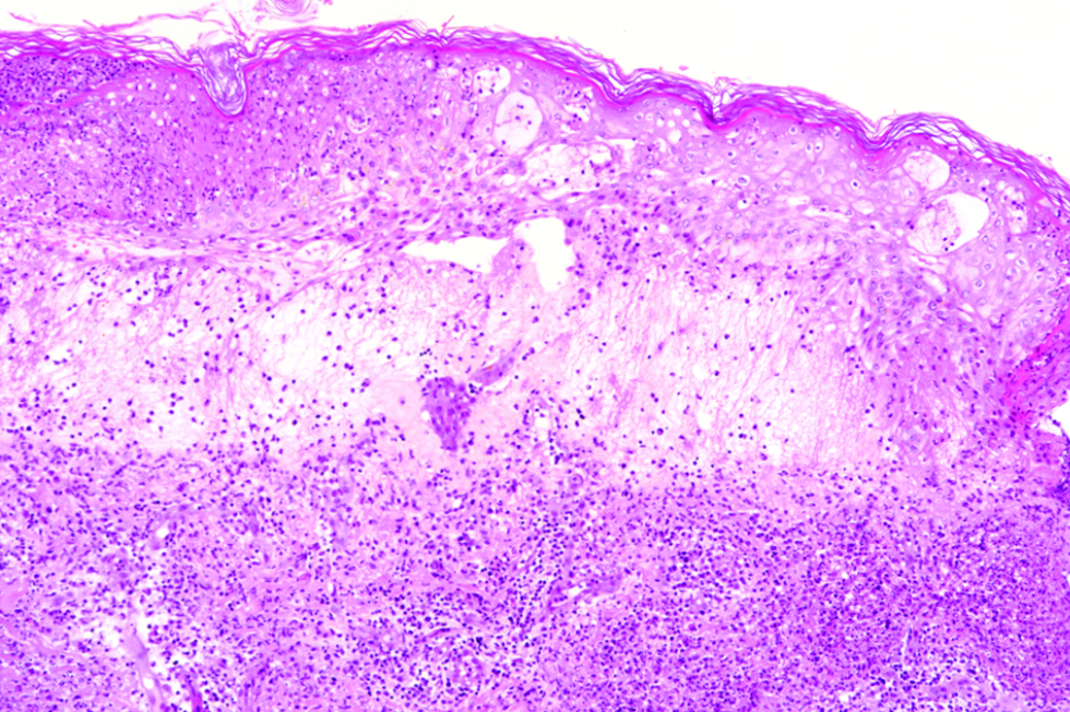 Skin biopsy from an edematous papule on the leg showing focal epidermal necrosis with collections of neutrophils, intra-epidermal vesicles, marked papillary oedema and diffuse dermal neutrophilic infiltrate with nuclear dust (H and E, × 100)