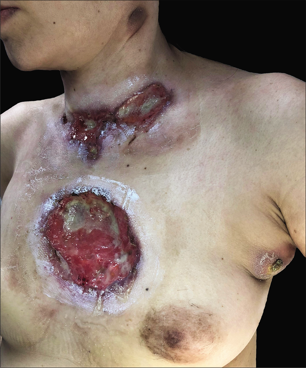 Large ulcers with undermined borders on the anterior chest, along with suppurative cervical and axillary nodules