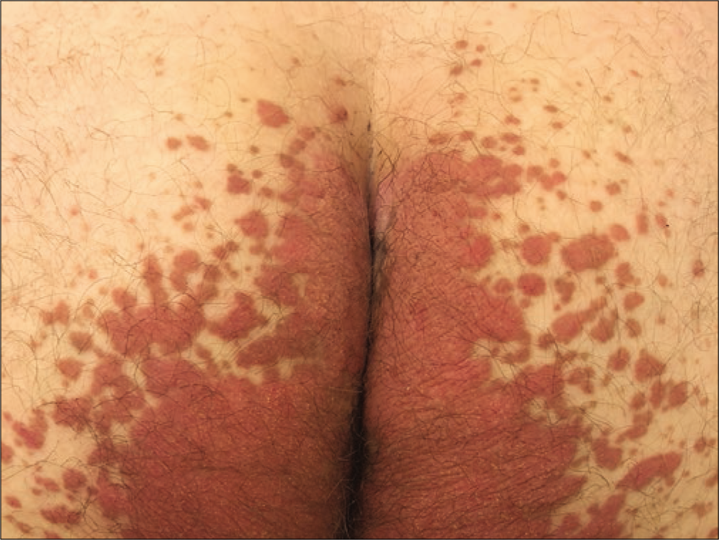 Butterfly-shaped hyperkeratotic erythematous plaque, bilaterally and symmetrically situated on the buttocks