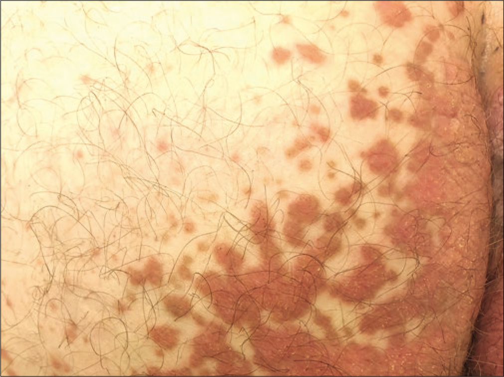 Red-brown discrete hyperkeratotic papules within the vicinity of main plaque