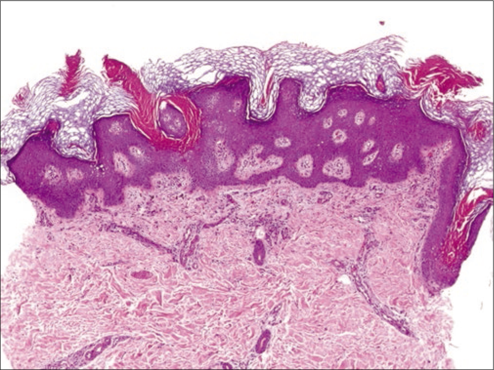 Multiple oblique columns of parakeratosis, alternating with hyperkeratosis and follicular plugging. Note irregular papillomatous proliferation of the epidermis (H and E, ×400)