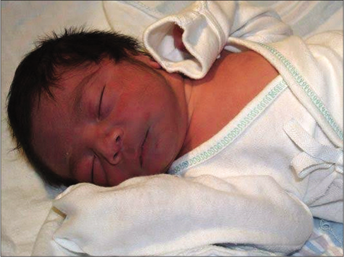 Blue baby with bluish discoloration of the face due to cyanotic congenital heart disease (Picture Courtesy: Dr. Amit Kumar, MD Paediatrics, ICH, Chennai)