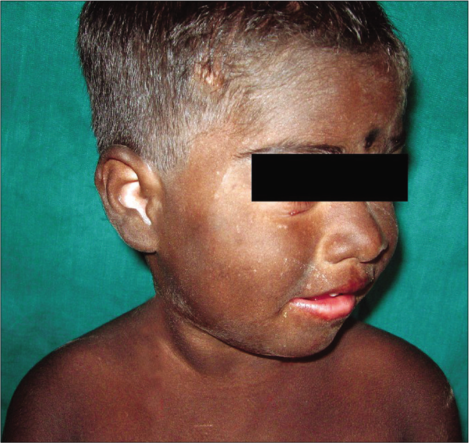 Carbon baby with diffuse hyperpigmentation (Picture Courtesy: Kaviarasan P K, Prasad P, Joe J M, Nandana N, Viswanathan P. Universal acquired melanosis [Carbon baby]. Indian J Dermatol Venereol Leprol 2008;74:38-40)