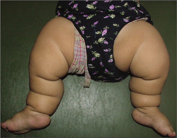 Michelin tire baby with multiple symmetric circumferential thick skin folds in the lower limbs (Picture Courtesy: Vora RV, Pilani AP, Diwan NG, RahulKrishna S. Michelin tire baby syndrome. Indian J Paediatr Dermatol 2016;17:226-8)