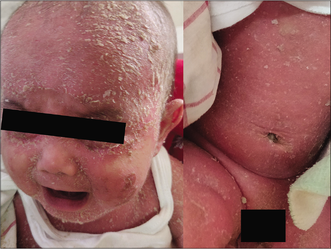 Red baby (neonatal erythroderma) due to infantile seborrheic dermatitis