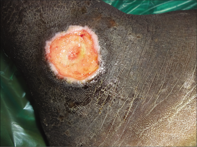 Well-defined punched out ulcer over the right lateral malleolus