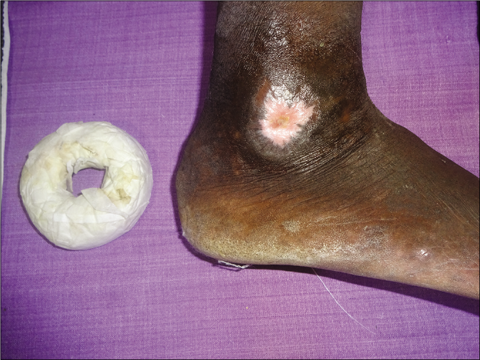 Ulcer showing almost complete healing following application of the bangle