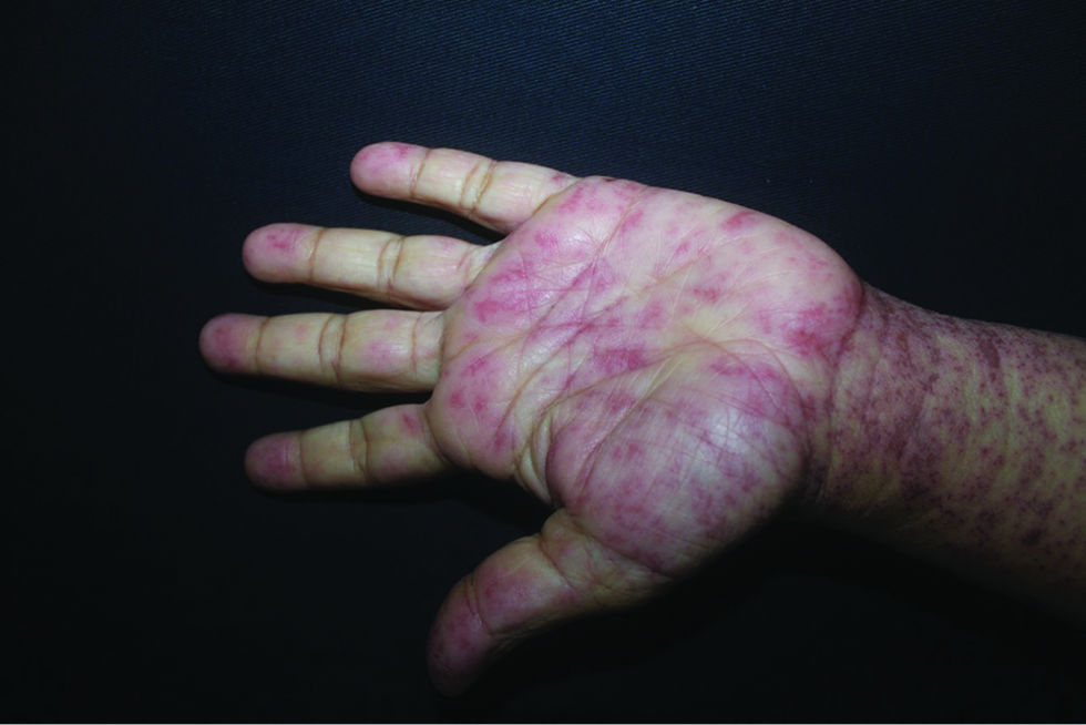 Atypical target lesions on the palm of the hand