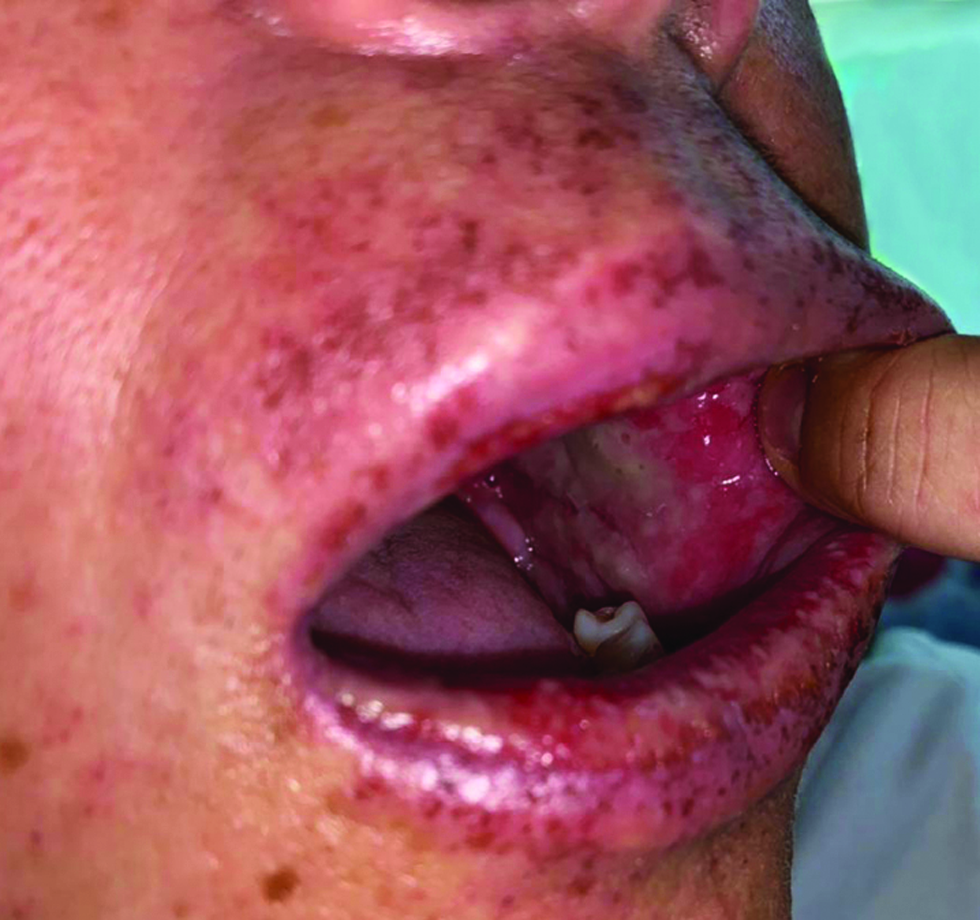 Erosions on the oral mucosa covered with exudation