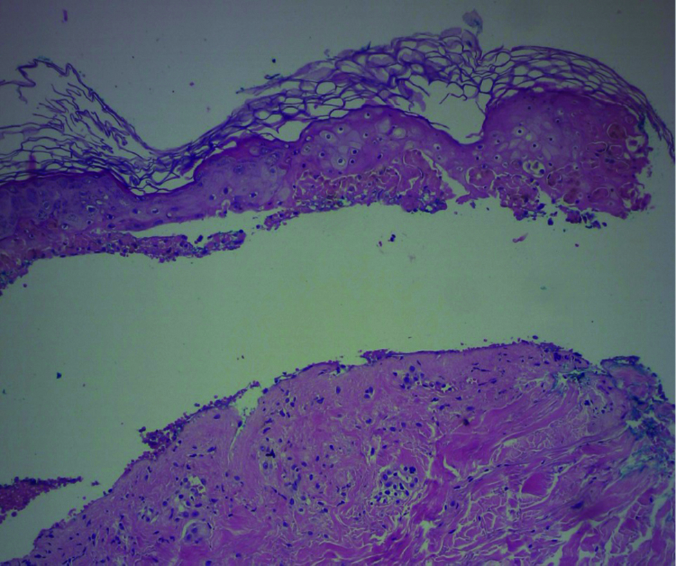 Histopathology shows necrosis of keratinocytes with detachment of the epidermis accompanying a mild lymphocytic inflammatory infiltrate (HE × 100)