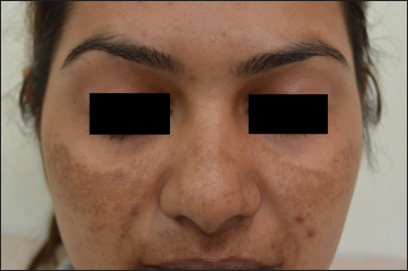 Melasma, face (Before skin camouflage therapy)