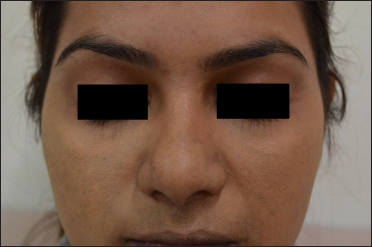 Melasma, face (After skin camouflage therapy)