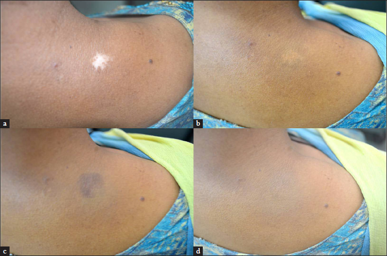 (a and b) Vitiligo patch pre- and post-application of only matching skin tone giving partial concealment, (c and d) vitiligo patch with colour correction using a dark brown tone and then application of matching skin tone, providing complete concealment