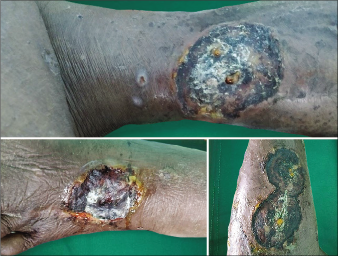 Lesions at the time of admission