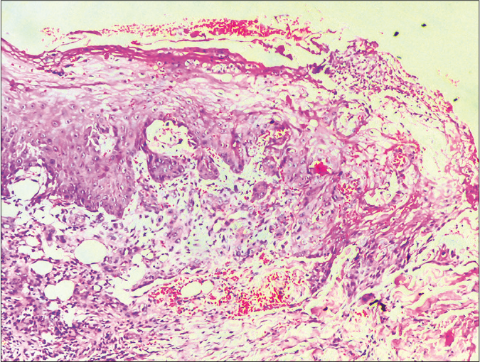 Histopathology section from the ulcer margin (H and E, ×200) showing focal ulceration and necrosis of epidermis, and edema, hemorrhage and granulation tissue formation involving the whole of dermis up to subcutaneous tissue