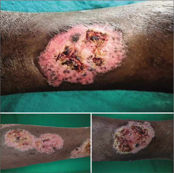 Lesions after 15 days of admission