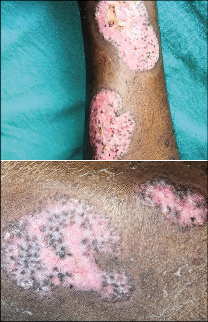 Lesions at discharge of the patient