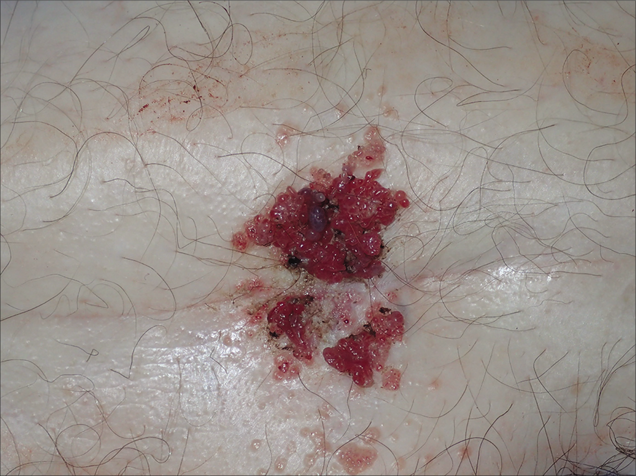 Grouped multiple, red and translucent small cysts-like lesions (“frog spawn” pattern) in a fold of the pubic region