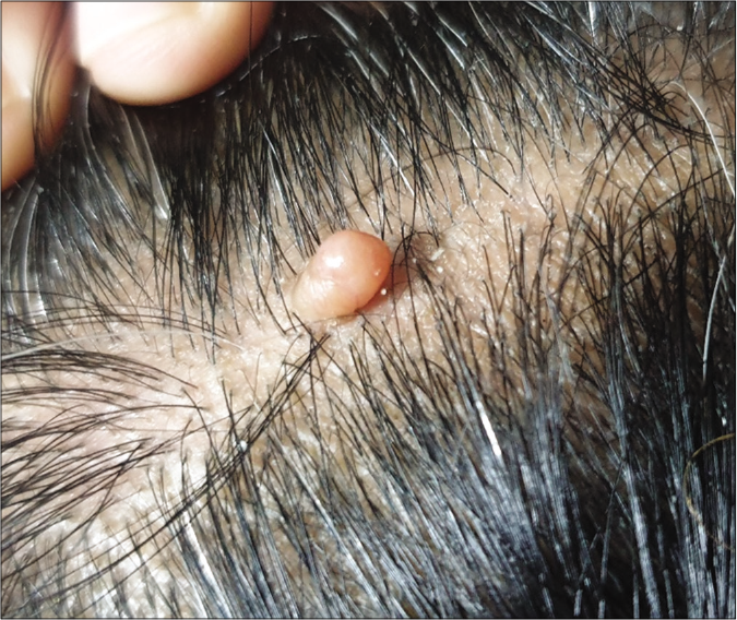 Broad-based pedunculated skin-colored nodular lesion