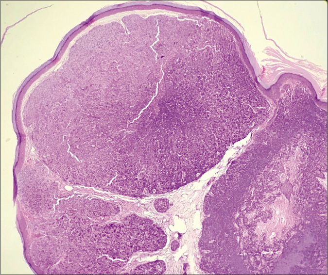 Multiple tumor islands with intervening stroma in the dermis (H and E × 40) scanner view