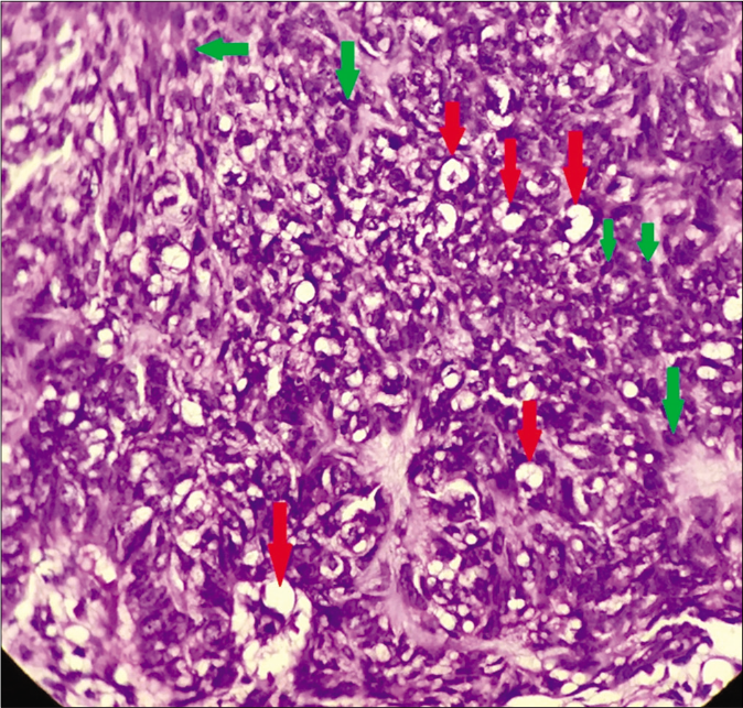 Admixture of basaloid cells (green arrows) and scattered mature sebocytes (red arrows) within tumor islands (H and E ×400)