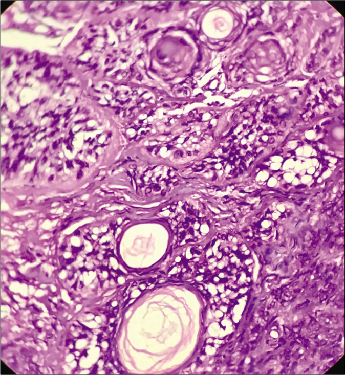 Ducts and cystic structures with mature sebocytes (H and E ×400)