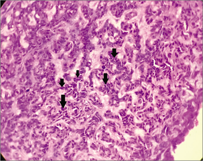 Labyrinthine/sinusoidal pattern of basaloid cells (black arrows) (H and E ×400)