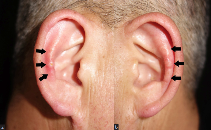 Multiple firm skin-colored papules (arrows) on the bilateral antihelixes: (a) right, (b) left