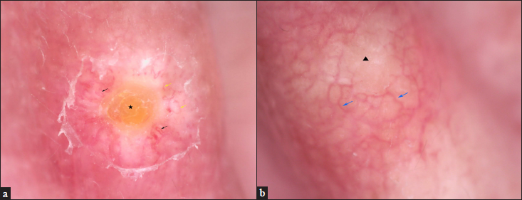 (a) The right lesion showed central yellow crust (pentagram) and peripheral linear (yellow arrows) and hairpin vessels (black arrows) on a white background. (non-contact polarised dermoscopy, ×50); (b) the left lesion showed central yellowish-orange structureless area (triangle) with the peripheral capillary network (blue arrows). (non-contact polarised dermoscopy, ×50)