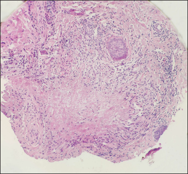 Dermal palisading infiltration contained histiocytes and lymphocytes around degenerated collagen fibres (H&E, ×200)