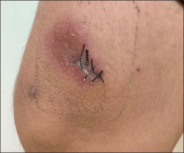 A dark, poorly circumscribed indurated plaque on the right lower thigh