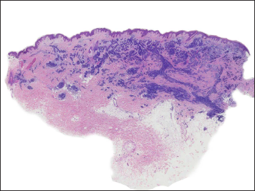 An infiltrative and poorly circumscribed neoplastic proliferation throughout the dermis and extending to the subcutis (H&E, original magnification ×20)